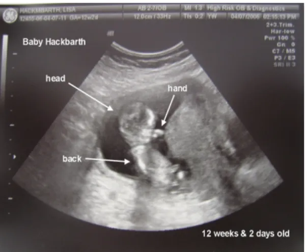 Figure 3.6. A fetus image 