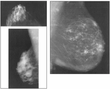 Figure 3.9.The image of micro calcifications in digital mammography 