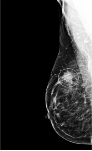 Figure 4.1. Right craniocaudal mammogram with the smallest bounding box (circle) containing  the entire lesion considered as ground truth for the evaluation of the detection algorithm