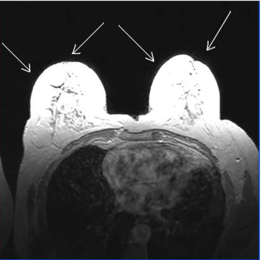Figure 3.2 shows the noise (artifacts) on breast boundary. These artifacts cause  segmentation of the breast image unsuccessfully