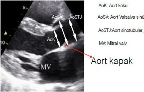 Şekil  2.4.  Çıkan  Aorta'nın  Parasternal  Uzun  Eksende  Görüntüsü  ve  Aort  Çapları 