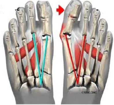 Şekil 2.8. Normal ve halluks valguslu ayak (Foot and Ankle 2002). 