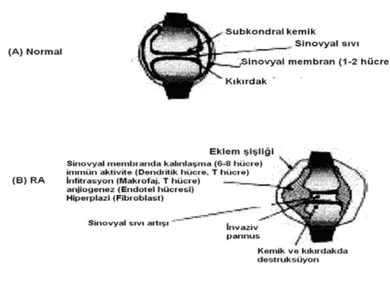 Şekil 1.2. Normal (A) ve romatoid artrit (B) ekleminin morfolojik görünümü  (Paleolog ve Miotla 1998/1999)