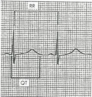 Şekil  2.9:  Kinidin  alan  bir  hastada  anormal  QT  uzaması.  QT  intervali  (0.6  sn)  kalp  hızı  için  (65  vuru/dk) anormal biçimde uzamıştır (Bkz