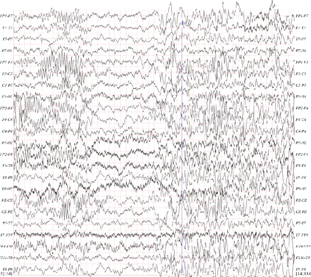 Şekil 2.1. Kanallardaki EEG grafikleri (Anonim 2011b) 