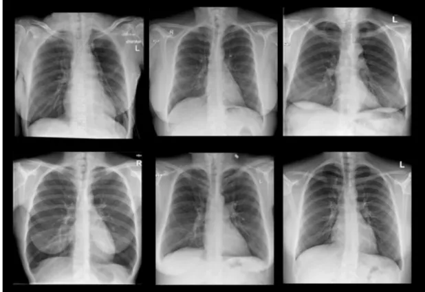 Figure 1.1: Radiographic Image Samples Of Chest  1.1.2  Fluoroscopy 