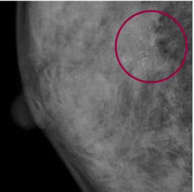 Figure 1.3: Mammographic Image With Anomaly Marked Red Circle 