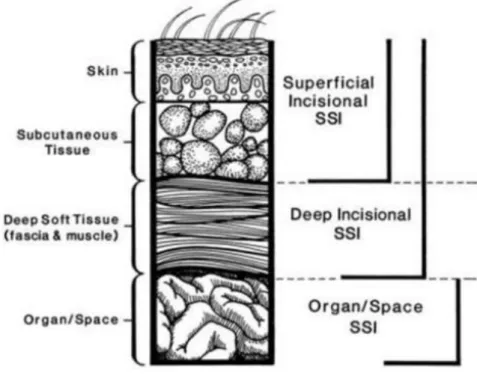Figure 1.1: SSI classification depend on deepness infection  1.1.3 Ventilator Associated Pneumonia 