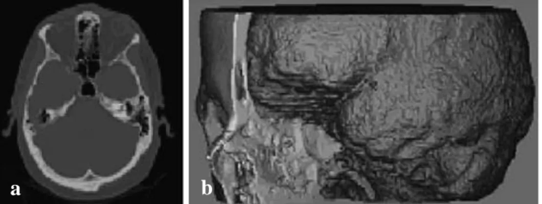 Figure 2.17 : a. 2D CT image, b. CT-derived 3D model of skull and brain (Sun et al.  2004)