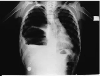 FIG. 1. Chest X ray showing left tension pneumothorax and an in-