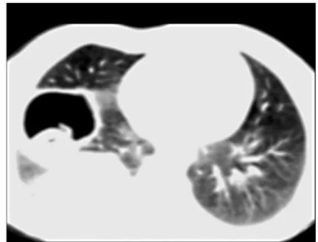 Fig. 1. Axial CT section in narrow window width shows hypodense cystic