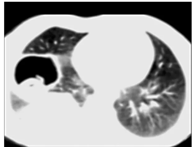 Fig. 1. Axial CT section in narrow window width shows hypodense cystic