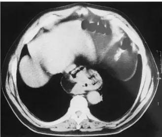 Fig. 1 Coexistence of both hernias in the computed tomography  scan