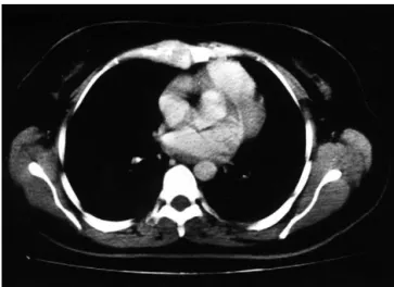 Fig 2. The technetium 99m methylenediphosphonate scintigraphy illustrates a focal zone of increased tracer uptake on the corpus sterni.