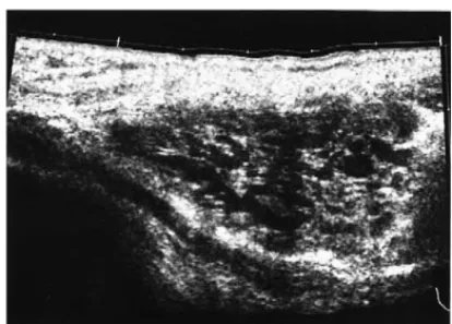 Fig. 1. US section shows an anechoic lesion intermixed with echogenic thick septations within the fibrils of pectoralis major muscle.