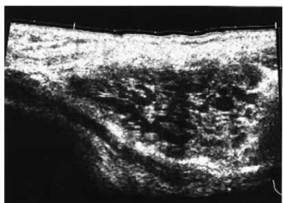 Fig. 1. US section shows an anechoic lesion intermixed with echogenic thick septations within the fibrils of pectoralis major muscle.