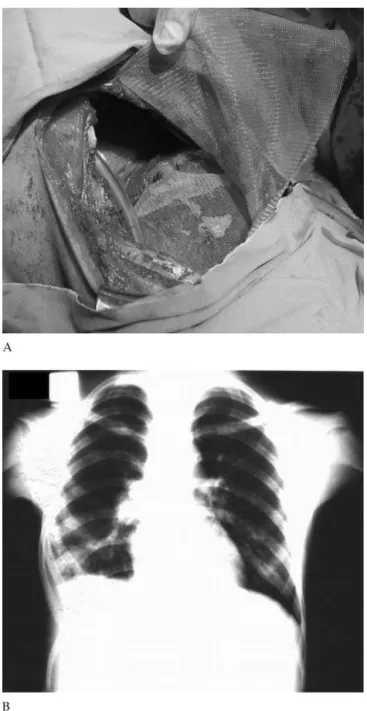 Fig 2. (A) The reconstruction of diaphragm and thorax wall defects with Prolene patch