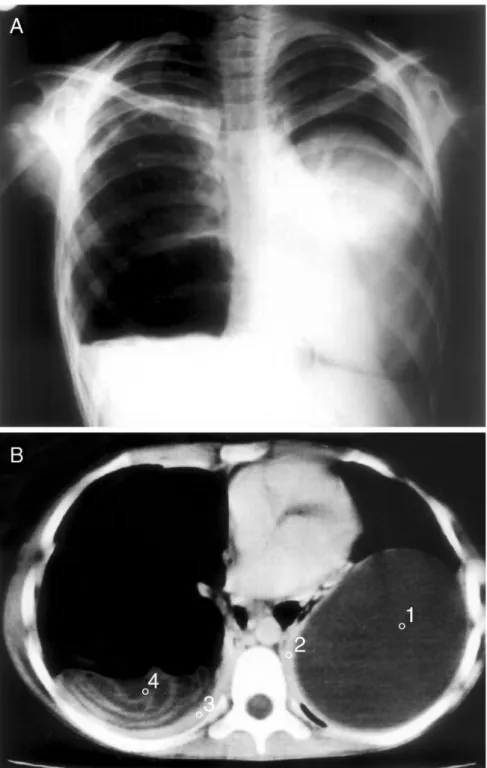 Figure 2 Ruptured right and intact left lung hydatid cysts in the chest radiograph (A) and thorax CT scan (B)