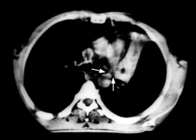 Figure 1.  CT scan at the level of the left upper lobe  bronchus shows an endobronchial mass with distal atelectasis  (Arrows).
