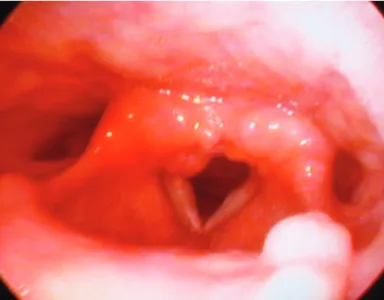 Figure 4. Thickening of the vocal cords, thickening and 