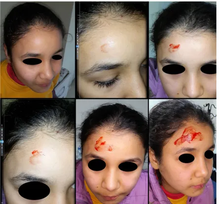 Figure 1 Clinical examination of an 11-year-old girl shows bleeding on the right side of the forehead that occurs when the subject moves from a cold to a warm environment