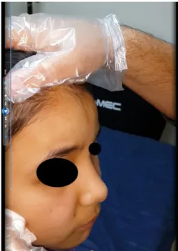 Figure 2 When the area of bleeding is wiped with sterile gauze with a few drops of adrenaline, the bleeding is observed to stop