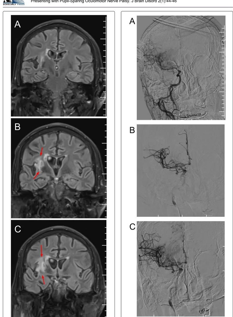 Figure 2: Brain Magnetic Resonance Imaging (MRI) shown  right peri-insular old infarct (red arrow).