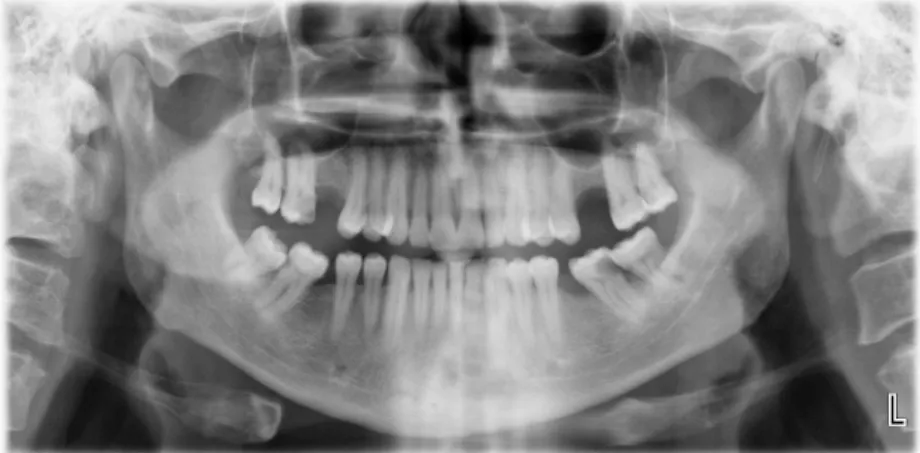 Fig. 1. Orthopantomograph image of the patient.  