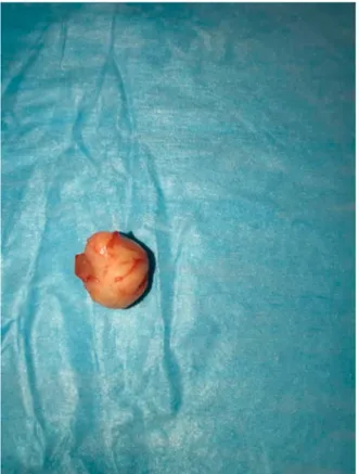 Fig. 3. Excised specimen of a well-circumscribed, yellow, lobulated tumor.  