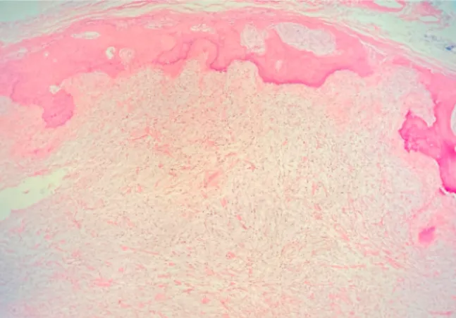 Fig. 4. Tumor covered with a peripheral ossifying layer with an inner myxohyaline component