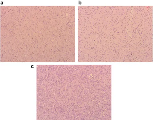 Fig. 4. Histologic appearance showing fascicles of spindle fibroblastic proliferation of desmoplastic fibroma (a)