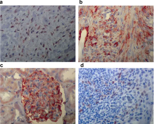Fig. 6. Control immunostainings: Desmoid-type soft tissue fibromatosis used as control tissue and showed strong nuclear beta-catenin immunopositivity (a)