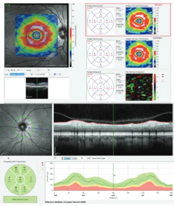 Figure 1. A sample of the ganglion cell and nerve fiber thicknesses report 