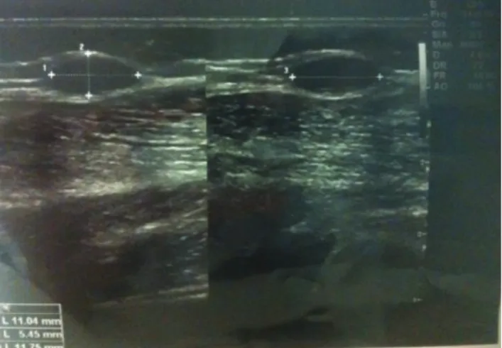 Figure 1.  First ultrasonografic image