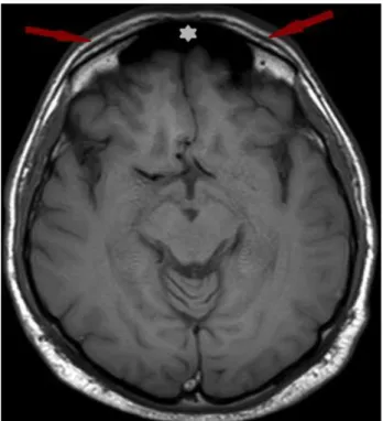 Fig  2.  On the  axial  T1  weighted  images  obtained at  a  63 