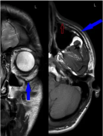 Fig 5. SMAS at infraorbital region at a 19 years old male 