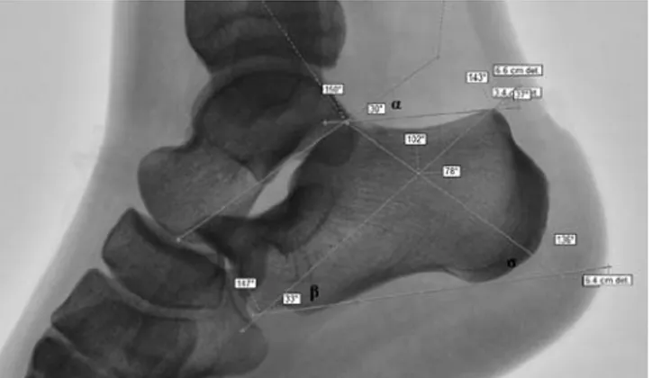 Figure 2. Tuber angle ( αα), anterior angle (ββ) and tuber plantare angle (∑ ∑).