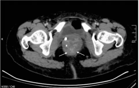 Figure 4.  At fused PET-CT image, a high standardized uptake value (SUV) of 5.8 at the upper-middle  part of rectum is demonstrated.