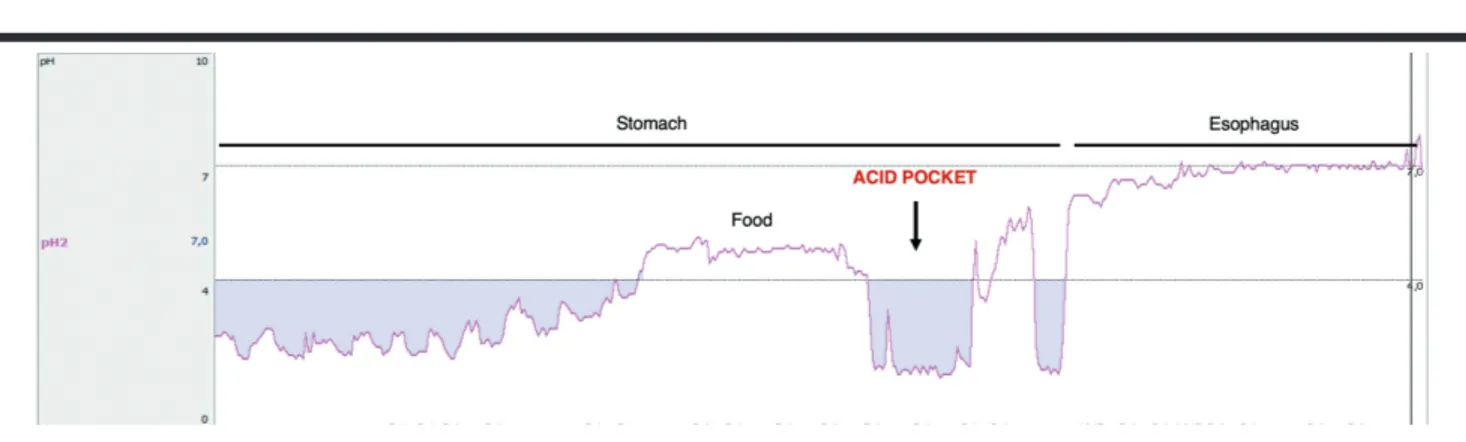 Figure 5. Acid pocket, as measured with a pH catheter, in the proximal stomach following food intake (Ege University School of Medicine,  Motility Lab).