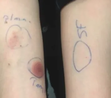 Figure 4.  Control injection of saline