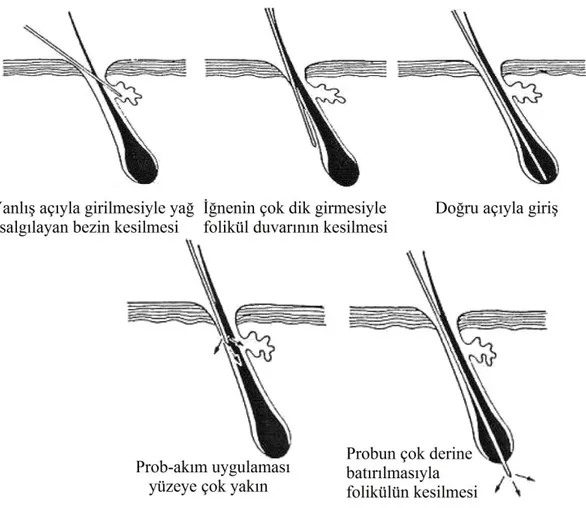 Şekil 2.4. İğneli epilasyon doğru ve yanlış kullanım örnekleri [3] 2.5.2.  Işıklı Epilasyon Yöntemleri 