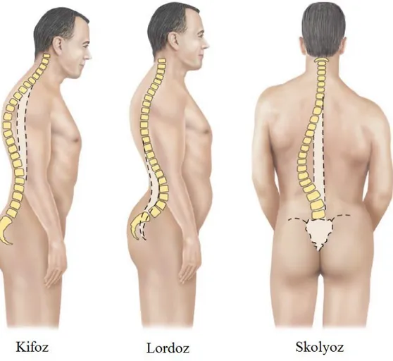 ġekil 1.9. Kifoz, lordoz ve skolyoz oluĢumu  [37]. 