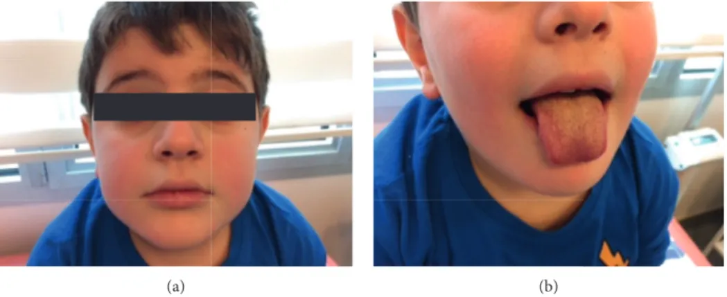 Figure 1: Nonpurulent conjunctivitis, malar rash, and mucosal changes on the lip and on the tongue.