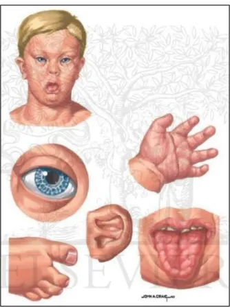 Şekil 2.3. Down sendromlu çocukların tipik özellikleri  Kaynak: Gerçeksever, 2011: 5. 