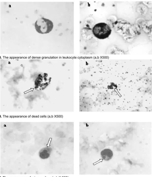 Figure 3. The appearance of dense granulation in leukocyte cytoplasm (a,b X500) 