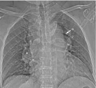 Figure 2. Axial contrast-enhanced CT image shows sac- sac-cular aneurysm at the level of aorticopulmonary window