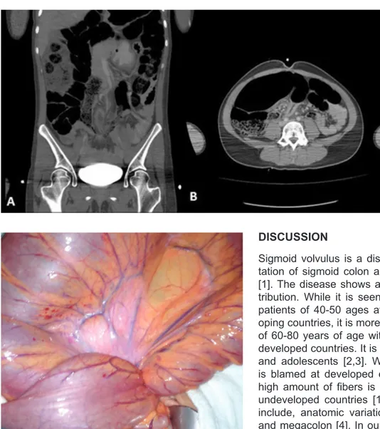 Figure 2.  A.  Sigmoid  Volvulus Observed on  Axial  Cross-Section  with  CT  B.  Sigmoid  Volvulus  Observed  on  Transverse   Cross-Section with CT
