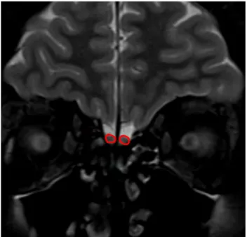 Fig. 1    Olfactory bulb volume measurement with magnetic resonance  imaging. Coronal T2-weighted image shows an example measuring  of olfactory bulb surface area