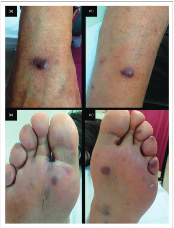 Figure 1. Blue/purple macular lesions on the posterior of the right forearm and posterior of right wrist (a/b), similar blue/purple lesions on 1st–3rd right toes, 4th and 5th left toes and bilateral heels (c/d).