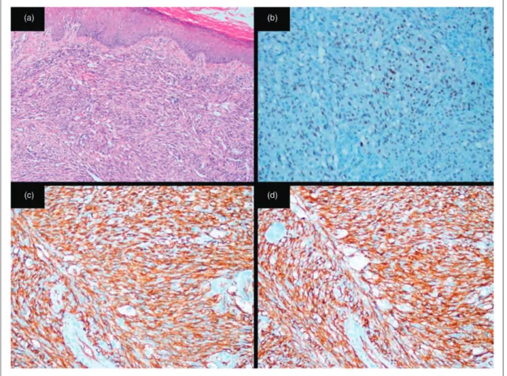Figure 2. H&amp;E 10; spindle cell proliferation with mild to moderate atypia, arranged in vague fascicles and separated by slit-like vessels (a), HHV20; Nuclear positivity with HHV-8 (b), CD3420; positive staining with CD34 (c), CD3110; positive stain